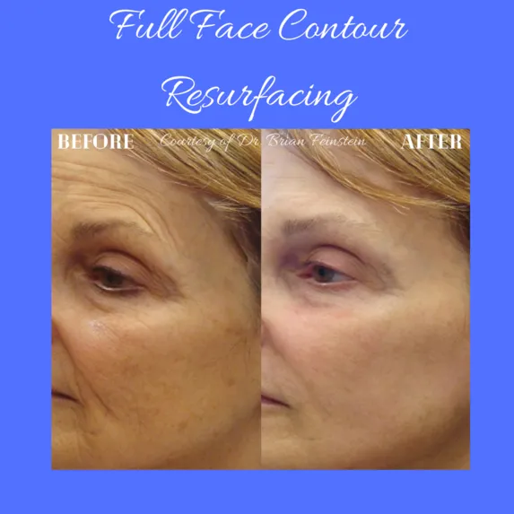 Full Face Resurfacing