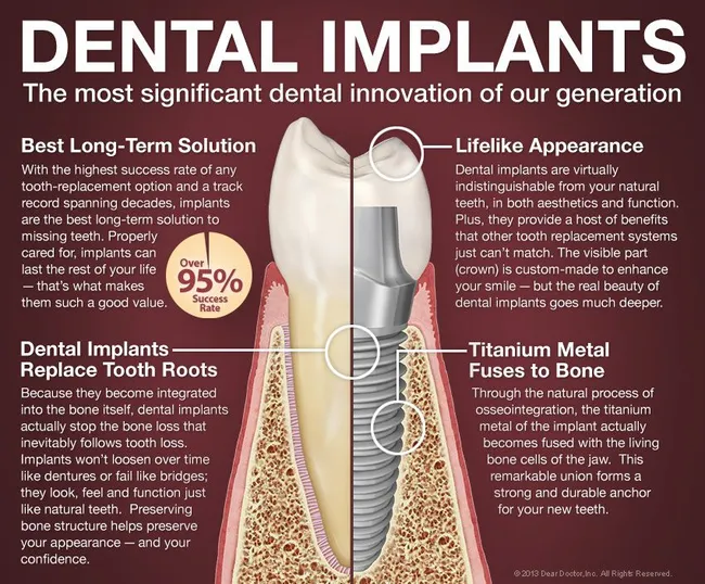 Dental Implants in Sequim, WA | Zbaraschuk Dental Care P.S.