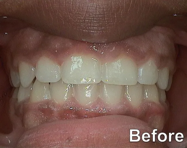 2015 Gummy Smile Before