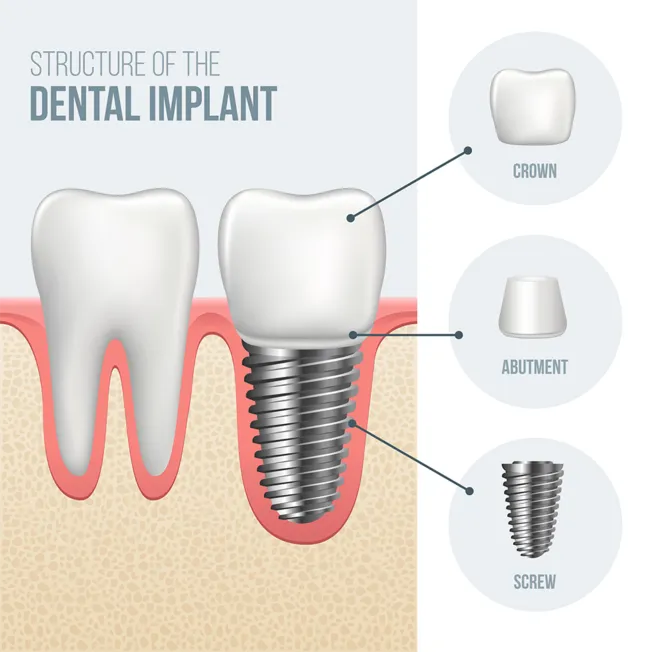 illustrated chart showing parts and placement of dental implants, implant dentistry Philadelphia, PA dentist