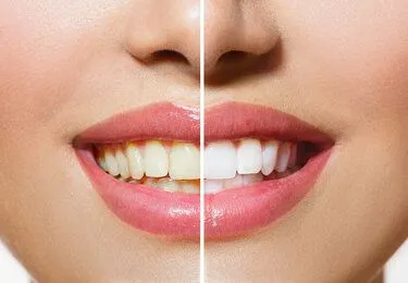 before and after image of woman's face, smiling mouth, left half has yellowed teeth, right half shows whiter teeth after professional teeth whitening Shelby, NC dentist