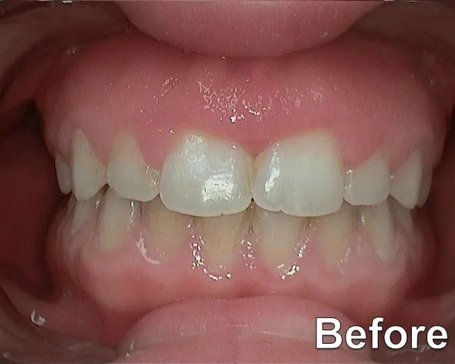 Gummy Smile 2016 before