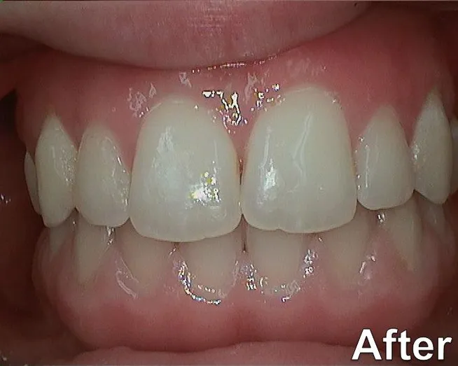 Gummy Smile 2016 after