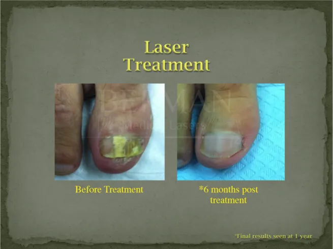 laser treatment