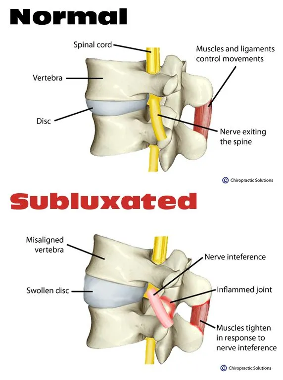subluxation_15110056.jpg