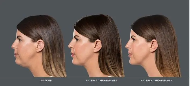 Kybella