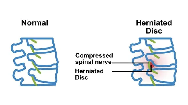 Herniated Disc Image
