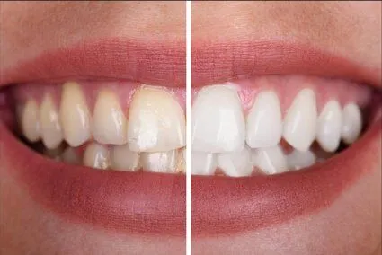 split image of woman's smiling mouth showing before and after results of teeth whitening, Warren, OH dentist