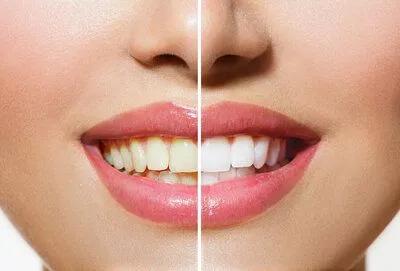 before and after images of woman's yellowed teeth then results from teeth whitening Russellville, AR dentist