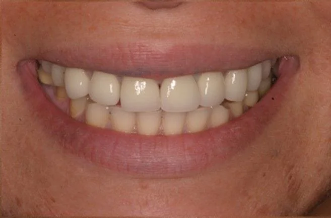 After by Dr. Asya Shor, North Babylon Dental