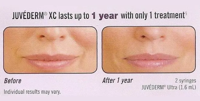Juvederm Before and After
