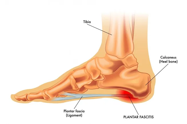 Plantar Fasciitis in Westbury, NY