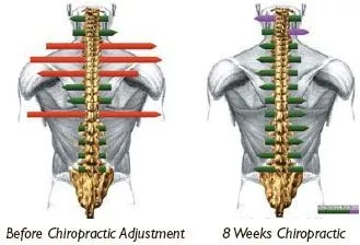 misalignment, muscle spasm, myovision scan, spinal manipulation, fort lauderdale chiropractor, fort lauderdale spinal adjustment