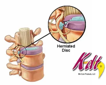 herniated disc