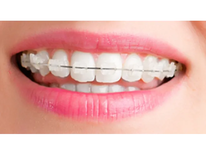 How Much Does Invisalign Cost in Redwood City?