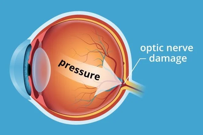 glaucoma-pressure