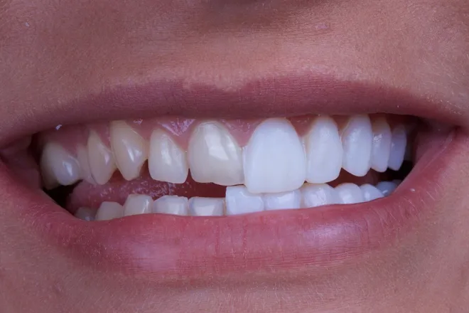 Veneers are an excellent way to redesign and reshape your entire mouth. Veneers are a very thin ceramic shell that covers your existing tooth structure. In placing these new veneers on your teeth, you are able to fix the look of issues such as staining, cracked teeth, spaces, misaligned teeth, chipped teeth and many other issues. In terms of the process to place veneers, it is a process that takes approximately two to three visits. In the first visit, we will discuss the new shape and look of what we are going to accomplish by placing the veneers. Once we have put a plan in place, we will carefully prepare the teeth for the placement of the new veneers. As we complete this piece of the process, the next step is to take an impression of the newly prepared teeth. This impression will be sent to our laboratory for the final product to be fabricated. We only utilize the highest standard laboratory for fabrication of all of our work. This process at the laboratory takes between 10-14 days. While the new veneers are being fabricated at the lab, we will provide you with a beautiful temporary solution to wear for this time. As the veneers are finalized, we will make every effort to make sure that your new veneers will feel just like your natural teeth. We will bond them into place ensuring that you can enjoy your new smile for a very long time!