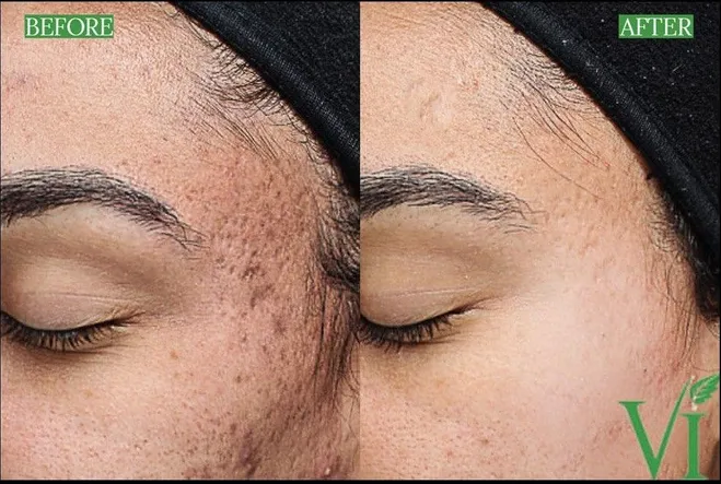 before and after vipeel