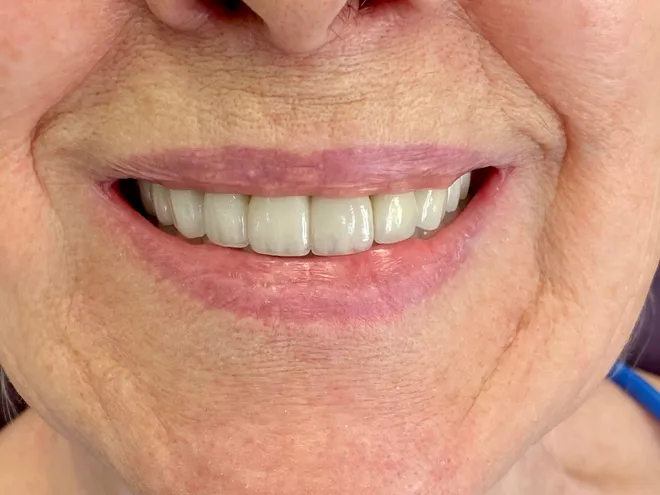 full mouth rehabilitation after