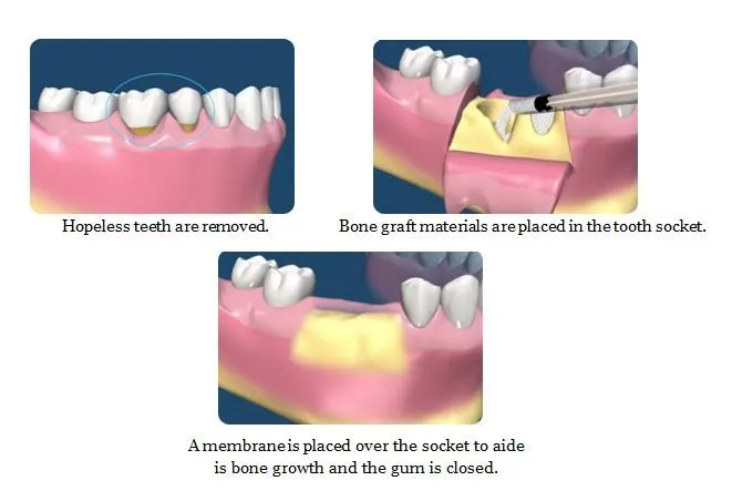 TruCare Dentistry Roswell - A dry socket is commonly seen after removing  the wisdom tooth. Read through this article to understand the cause, signs,  and treatment of a dry socket, usually after