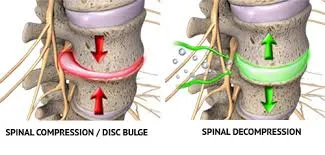 Spinal Decompression Tumwater Lacey