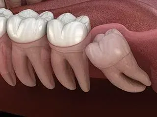 illustration of wisdom tooth impacted under gumline pushing against teeth, wisdom tooth extraction Melrose dentist 
