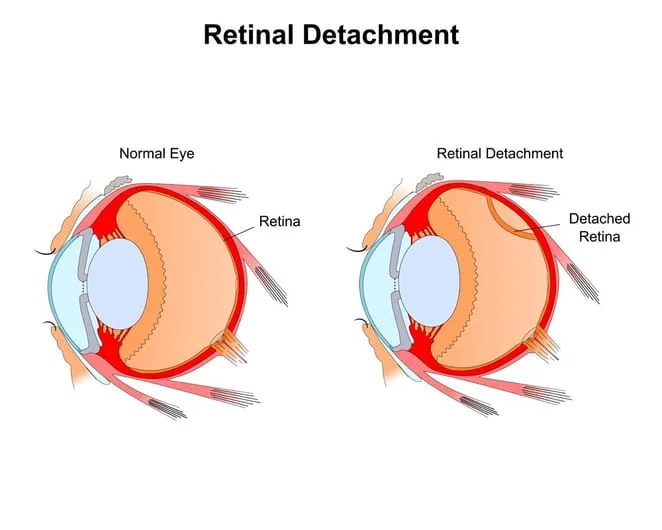 retinal detach