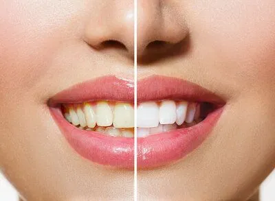 before and after photo of woman's teeth, yellowed on left, white on right after teeth whitening Acworth, GA and Alpharetta, GA dentist