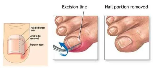 Painful thickened toenails — Mackay Ingrown Toenail Clinic