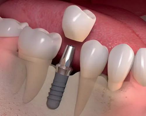 Dental Implants - Berryville, VA Dentist | Main Street Smiles: Ahmed Al Attar, DDS