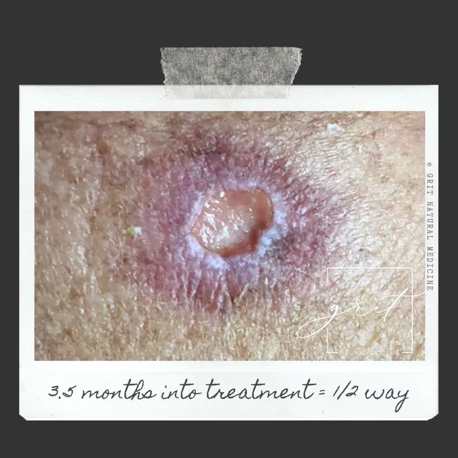 basal cell carcinoma