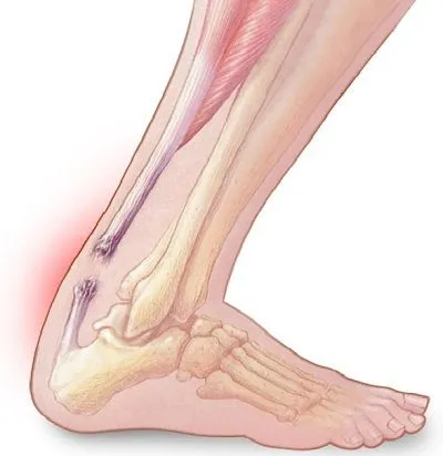 Achilles tendinitis, Achilles tendon pain