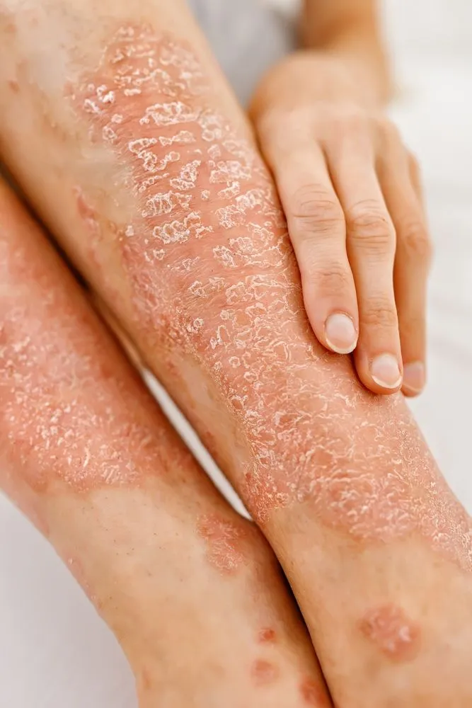 Biologics in Dermatology