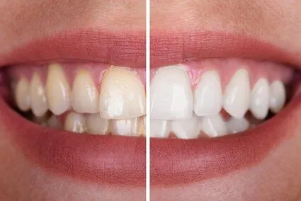 before and after image showing teeth bleaching results on smile, teeth whitening Decatur, IL teeth bleaching