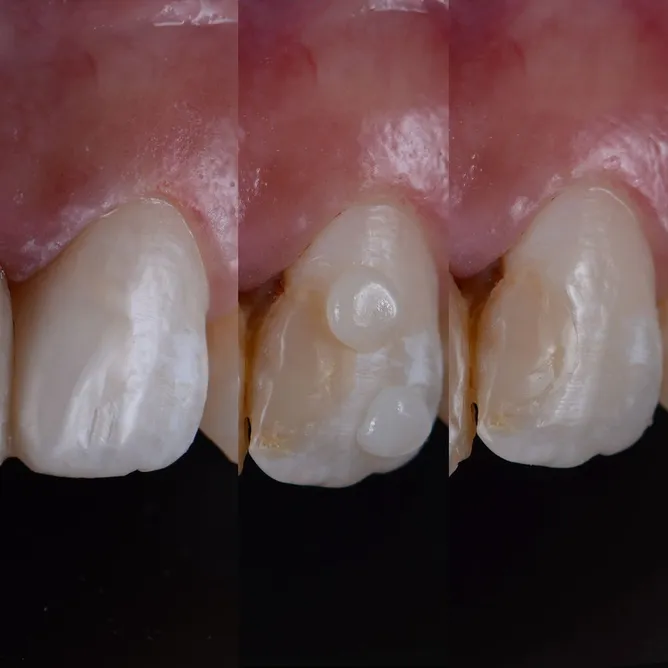 Before, During, and After Dental Fillings, Los Angeles, CA, Culver City, CA, Marina Del Ray, CA