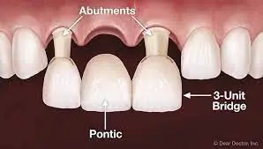 illustration of 3 unit dental bridge being placed over abutment teeth in top arch, dental bridge Mt Airy, NC dentist