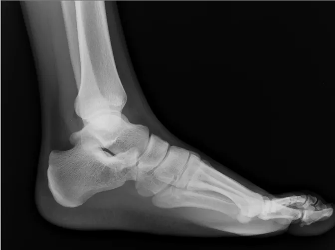 X-ray of foot