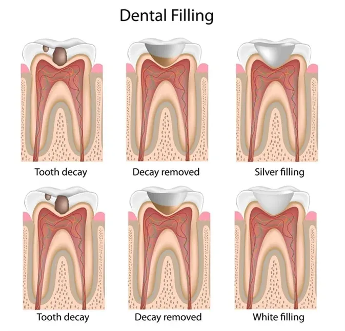 fillings