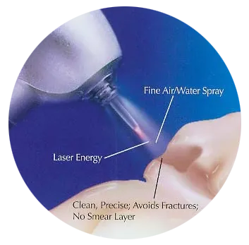 illustration of Waterlase dental laser being used on tooth, laser dentistry Longmont, CO