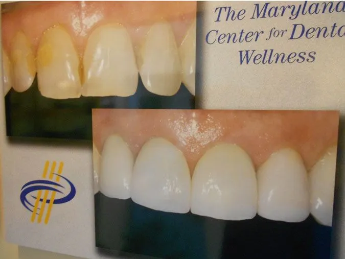 Smile Makeover