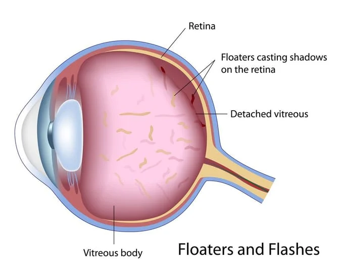 Illustration of floaters and flashes