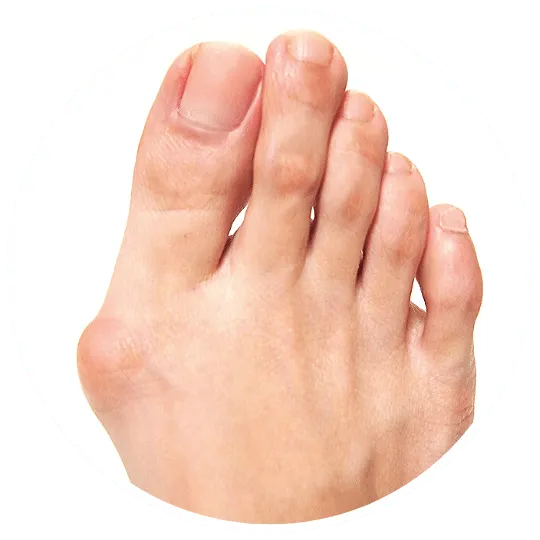 Bunion