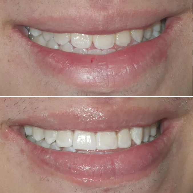 before and after images of dental bonding Brookline, MA cosmetic dentistry