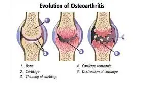 osteoarthritis