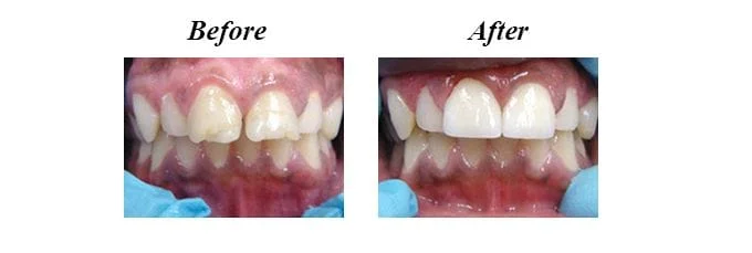 Crowns - Before and After