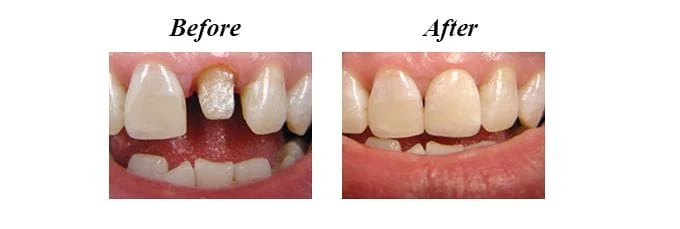 Smile Restoration with Crown
