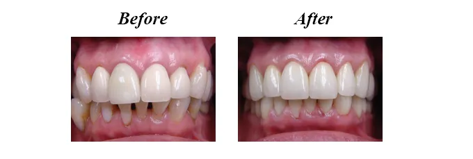 Lower Teeth Crowns