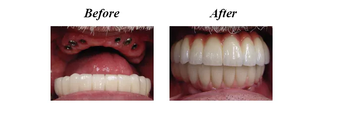 Full Mouth Implants