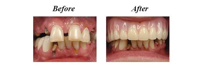 Partial Dentures - Before and After