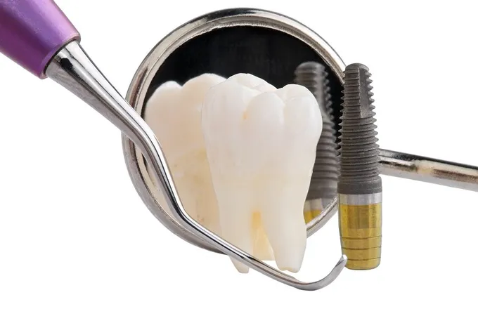 Dental Implants Flower Mound TX